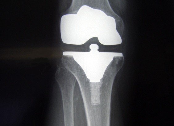 knee replacement - how it helps