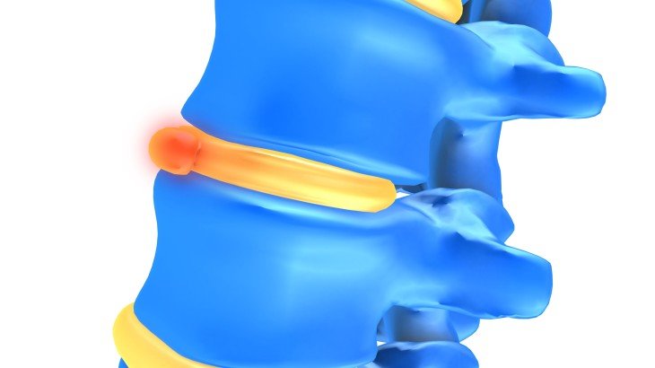 clip disc - low back pain