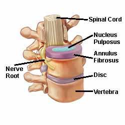 Cervical herniated disc_02