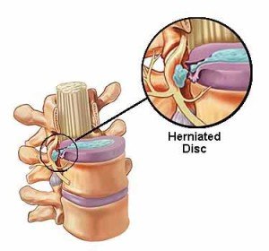 Cervical herniated disc_03