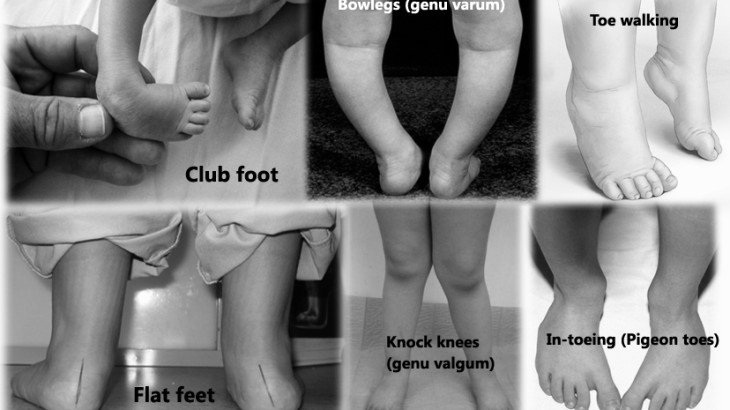 Pediatric Orthopedic Diseases