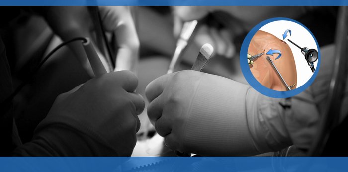 shoulder arthroscopy