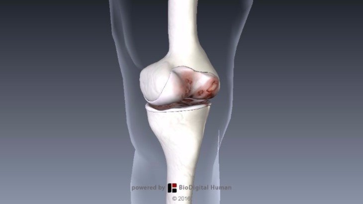 Osteoarthritis treatment