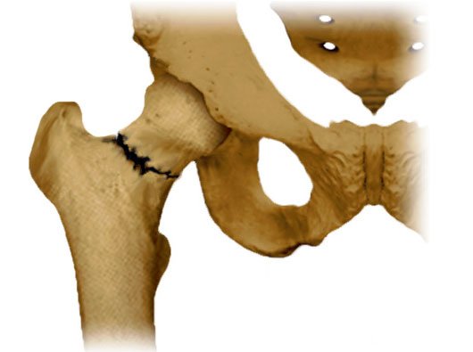 How hip fracture looks like