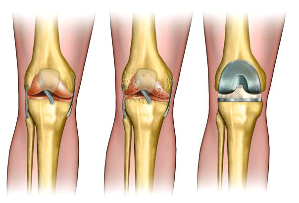 Knee Replacement Surgery