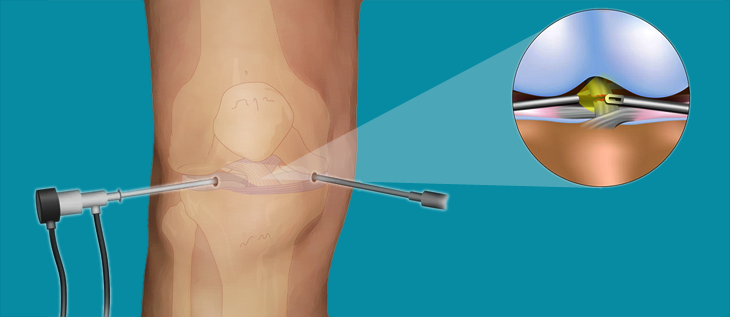 Arthroscopic Knee Surgery