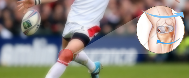 Image showing Meniscus tear