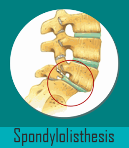 image showing Spondylolisthesis