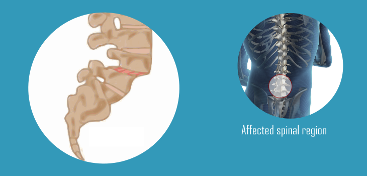 Top 10 Exercises for Spondylolisthesis-Cover image