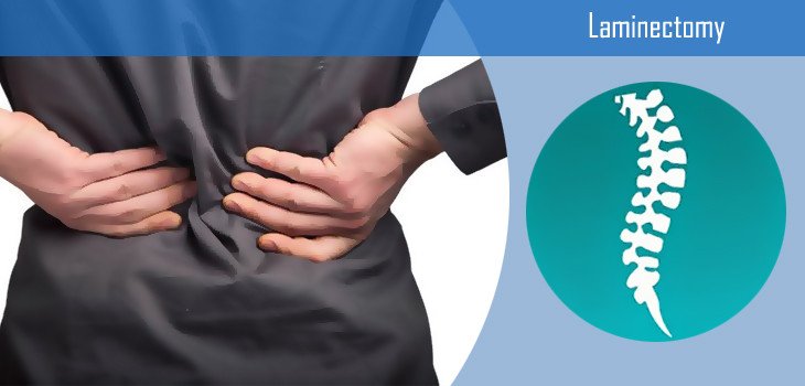 Laminectomy