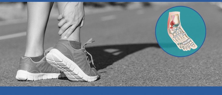 Ankle Sprain Injury