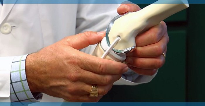 Assumptions about knee replacement surgery