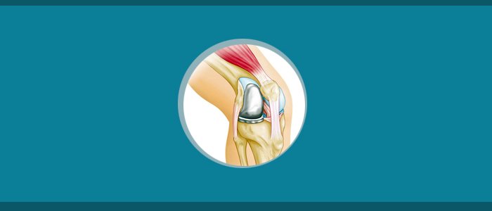 Partial Knee Replacement
