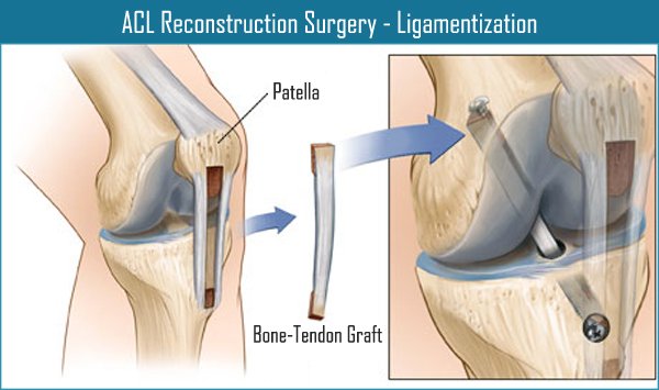 ACL-Surgery-Ligamentization