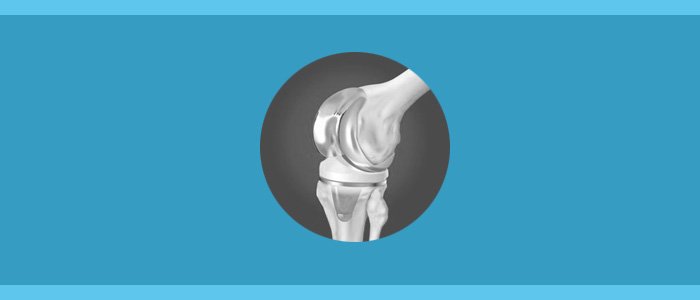 knee replacement Implant Recall List