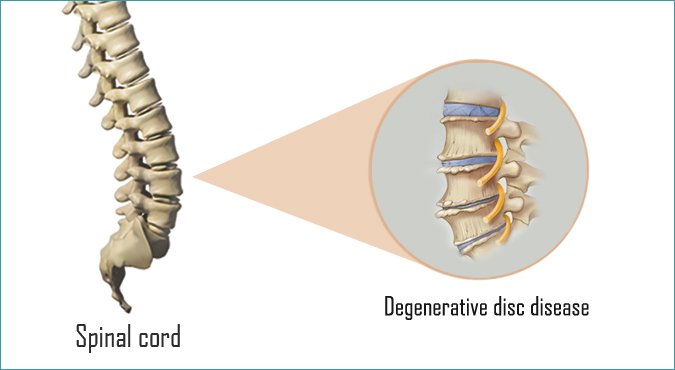 L5-S1 - All About Lumbosacral Joint