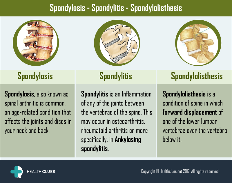 Ankylosing spondylitis spondylothesis