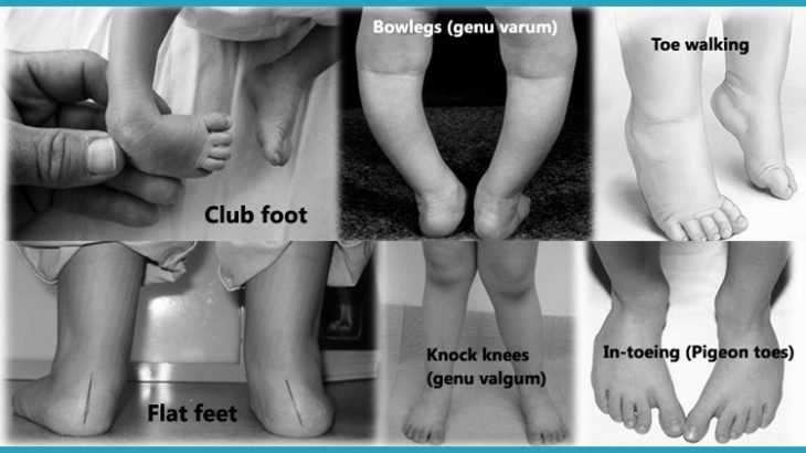 Club Foot