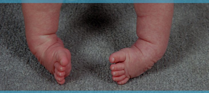 club foot