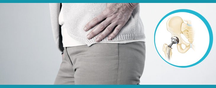 Should you delay a hip replacement surgery?