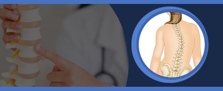 scoliosis