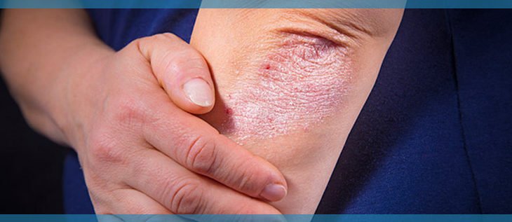 Is-PSORIASIS-Curable