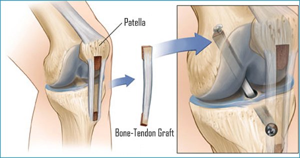 acl surgery cost acl surgery cost in india in bengali acl surgery cost acl surgery cost in india in bengali