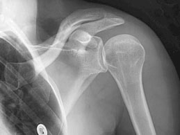 Shoulder joint x-ray X-ray image showing contracted shoulder capsule