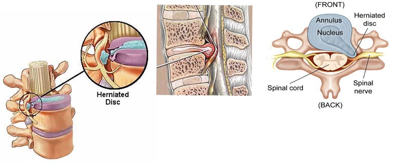 Hernicated disc and low back pain Herniated disc can cause chronic back pain