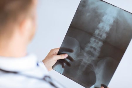 Back x-ray X-ray to determine cause of low back pain