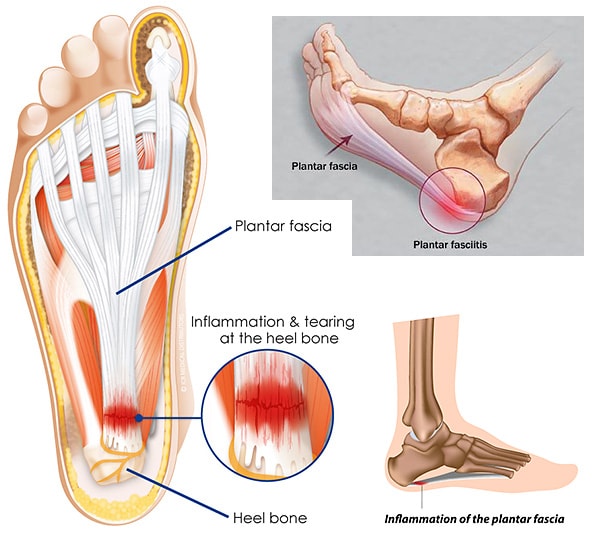 Inflammation of heels Heel anatomy and inflamed plantar fascia