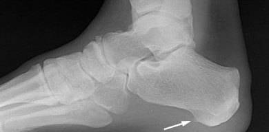 Heel pain diagnosis through X-ray X-ray of heel showing thickened plantar fascia