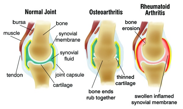 Healthy joint, OA and RA joint Diagram showing different between Osteoarthritis and Rheumatoid Arthritis