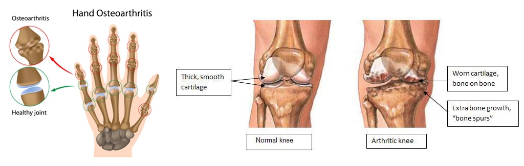 Arthritis palm and knee Arthritis impact on the palm and knee