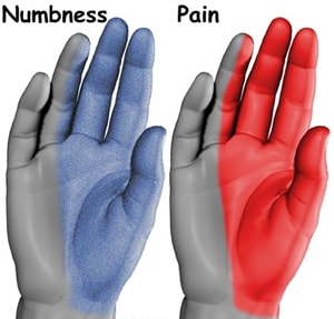 Palm numbness Palm numbness due to carpal tunnel syndrome