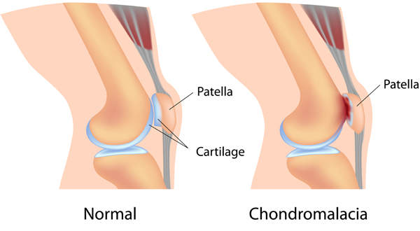 Normal and chondromalacia patella affected knee joints Diagram showing normal knee and chondromalacia patella affected knee