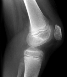 chondromalacia patella affected knee joint X-ray showing the affected knee with chondromalacia patella