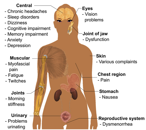 Symptoms of fibromyalgia Diagram showing Symptoms of fibromyalgia