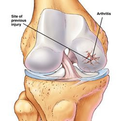 Knee joint and arthritis Arthritis affected knee