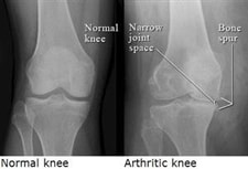 X-ray of arthritic knee Diagnosing a knee damaged by osteoarthritis