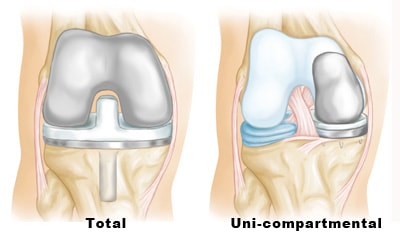 Surgery options for arthritis of knee Total joint replacement or uni-compartmental surgery for arthritis