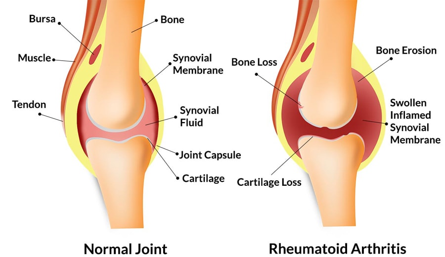 Bone erosion due to Rheumatoid Arthritis Bone joint showing Rheumatoid Arthritis symptoms