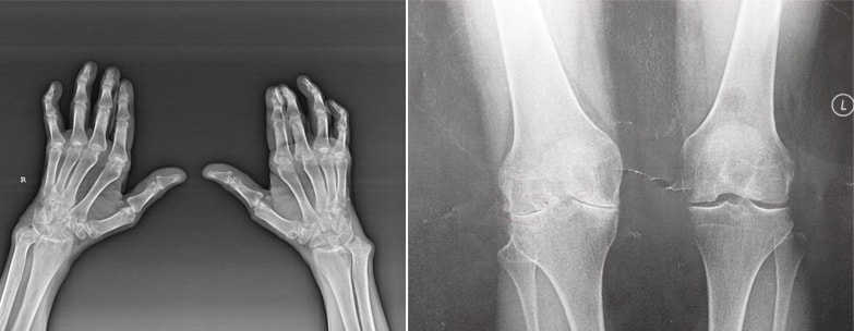 Joint deformity due to Rheumatoid Arthritis X-ray showing severe Rheumatoid Arthritis impact