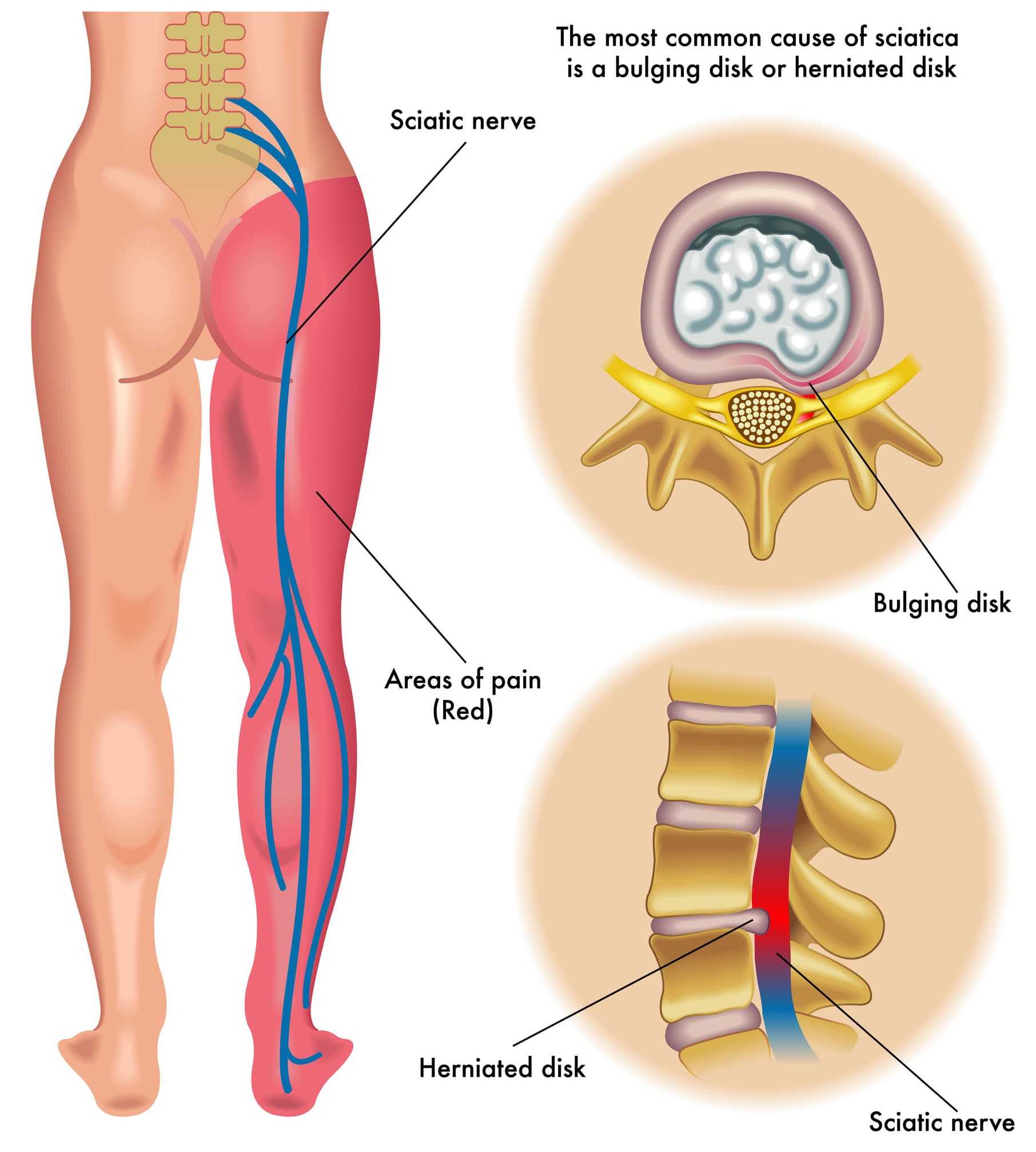 Bulkging disk - the most common cause of sciatica Diagram illustrating effected area of sciatica