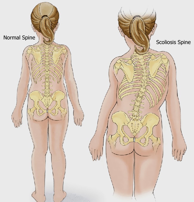 Scoliosis affected spine compared with normal spine Normal spine and scoliosis spine