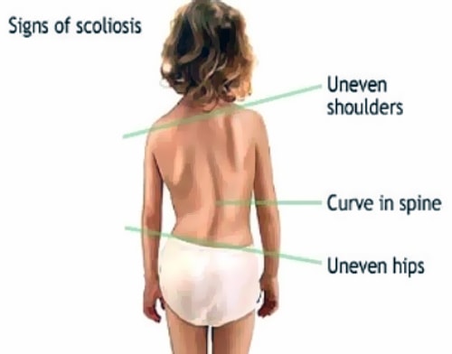 Child affected with Scoliosis Scoliosis spine signs