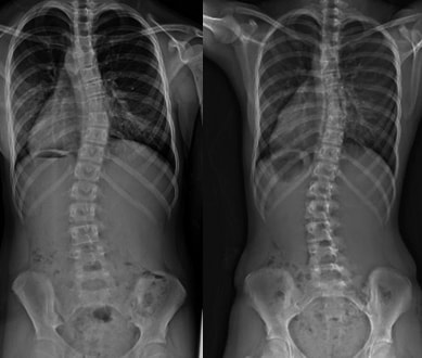 X-ray showing scoliosis affected spine x-ray of scoliosis spine