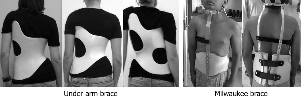 Under arm brace and Milwaukee brace Different options of braces to treat scoliosis