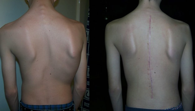 scoliosis spine correction with spinal fusion surgery Diagram of corrected spine pre and post surgery