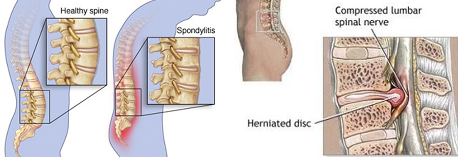 Spondylosis spinal damage Comparison of healthy spine and spondylosis effected spine